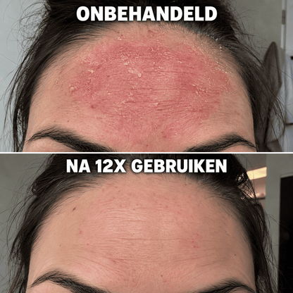 De Complete Huidherstel Kuur